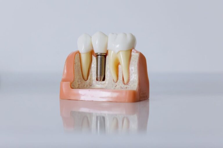 implantes dentales precio